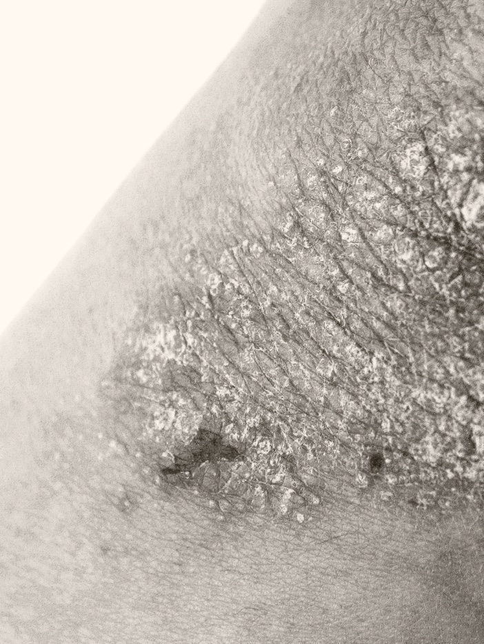 Patient with plaque psoriasis on elbow