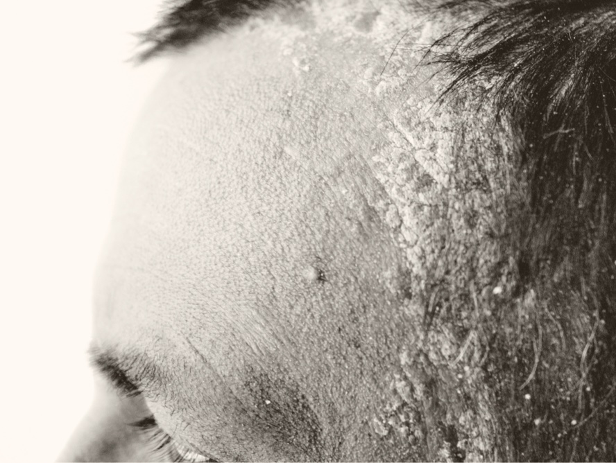Man with scalp psoriasis at hairline