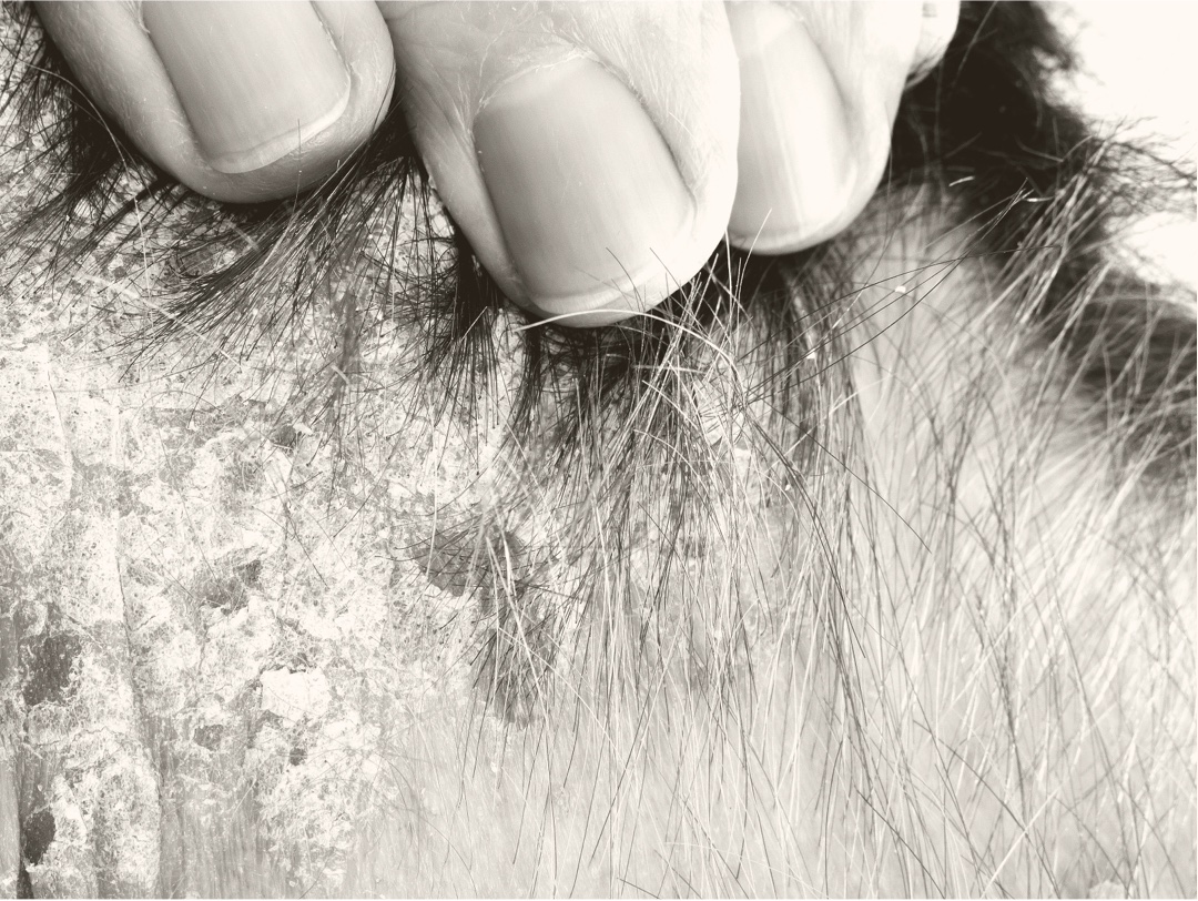 Patient with seborrheic dermatitis on hairline